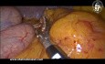 Une Technique pour Traiter les Vaisseaux Gastriques Courts près du Pôle Supérieur de la Rate pendant la Gastrectomie Sleeve