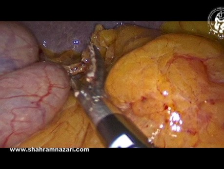 Une Technique pour Traiter les Vaisseaux Gastriques Courts près du Pôle Supérieur de la Rate pendant la Gastrectomie Sleeve
