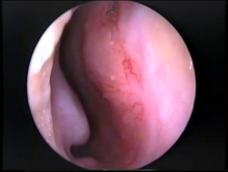 Vaisseaux Anormaux de la Zone de Little — Epistaxis