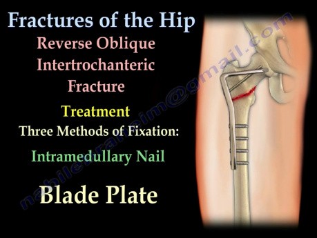 Fixation des fractures de l'extrémité proximale du fémur