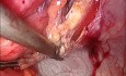 Hernioplastie par technique IPOM plus (cure par laparoscopie avec filet intrapéritonéal) 