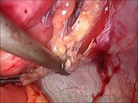 Hernioplastie par technique IPOM plus (cure par laparoscopie avec filet intrapéritonéal) 
