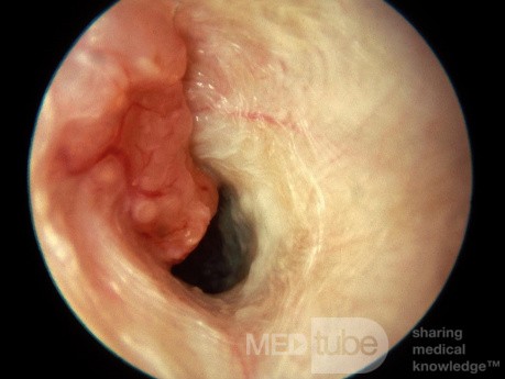 Adénocarcinome envahissant le conduit auditif externe