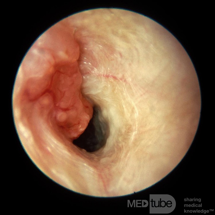 Adénocarcinome envahissant le conduit auditif externe