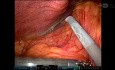 Cholécystectomie Robotisée pour Cholécystite Nécrosée Abcédée et Perforée