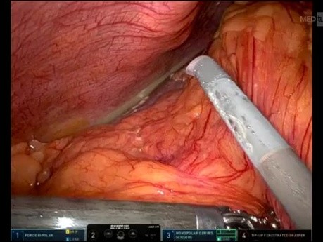 Cholécystectomie Robotisée pour Cholécystite Nécrosée Abcédée et Perforée