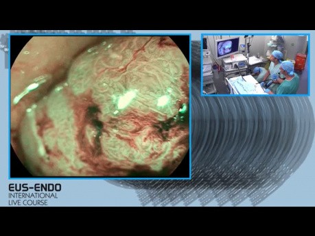 Stadification  du cancer avant résection - examen endoscopique et EER (échographie endorectale)