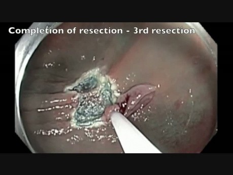 Côlon: Résection Muqueuse Endoscopique compliquée d'une perforation - partie 7