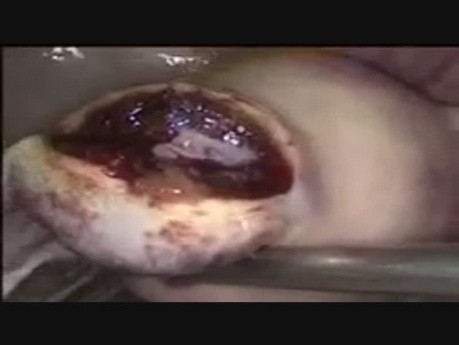 Grossesse ectopique dans une corne utérine