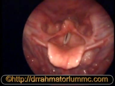 Utilisation d'un Endoscope à 70 Degrés - Marquage de Surface du Cartilage Thyroïde