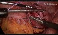 Myomectomie laparoscopique