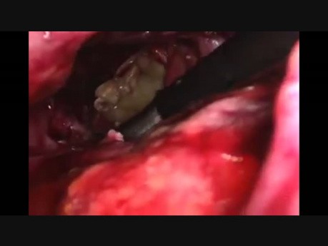 Nécrosectomie pancréatique par voie laparoscopique