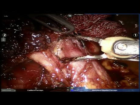 Chirurgie robot-assistée pour un cancer du lobe moyen