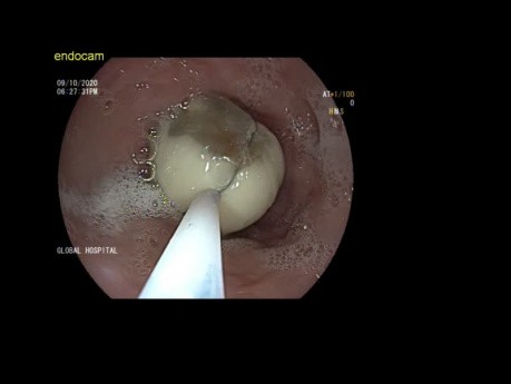 L'extraction endoscopique d'une gousse d'ail de l'œsophage.