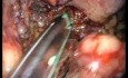 Pancréatectomie Distale et Splénectomie laparo-endoscopique à site unique (LESS)