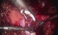 Dissection laparoscopique des ganglions lymphatiques pour récidive du cancer de la prostate