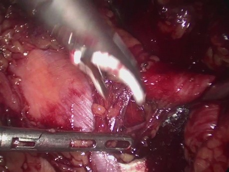 Dissection laparoscopique des ganglions lymphatiques pour récidive du cancer de la prostate