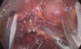 Hémicolectomie Gauche Elargie avec Laparoscopie Colorectale avec Excision Complète du Mésocolion et Anastomose Colo-Rectale Transverse avec Dérotation du Côlon Droit pour un Carcinome de l'Angle Splénique