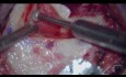 Approche Combinée de Chirurgie du Cholestéatome (Endoscopique et Microscopique)