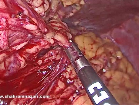 Volvulus: Complication Rare de la Gastrectomie Sleeve