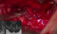 Ablation Mini-Invasive d'une Hernie Discale Volumineuse L5-S1 avec Arthrodèse Lombaire (TLIF)