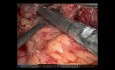 Oesophagectomie Transhiatale Robotisée pour Adénocarcinome Localement Avancé