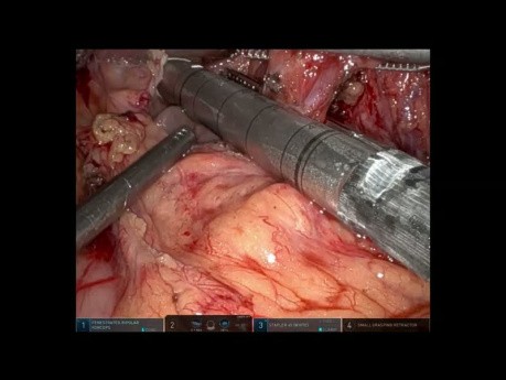 Oesophagectomie Transhiatale Robotisée pour Adénocarcinome Localement Avancé