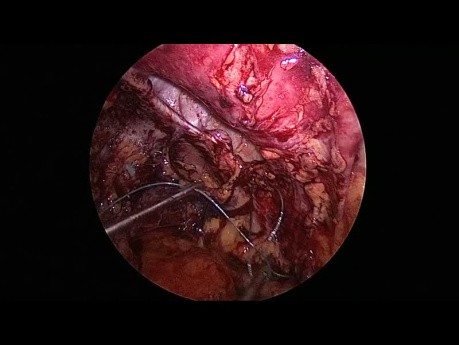 Réparation Laparoscopique Transabdominale Prépéritonéale Gauche de la Hernie L4