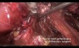 Hystérectomie complexe sur endométriose sévère