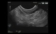 Lésion sous-muqueuse antrale, écho-endoscopie