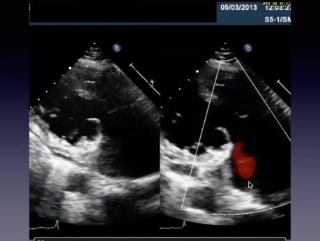 Pourquoi mon Patient est-il en insuffisance Cardiaque ? Cas d'Echo Difficiles et Astuces