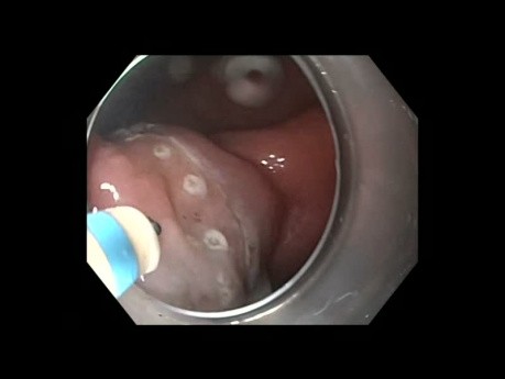 Traitement précoce du cancer gastrique