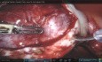  La chirurgie des endométriomes bilatéraux.