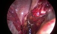 SILS (Chirurgie Laparoscopique à Incision Unique ) - Utilisation d'un Ecarteur Magnétique lors d'une Résection Antérieure Basse