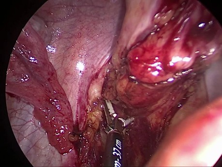 SILS (Chirurgie Laparoscopique à Incision Unique ) - Utilisation d'un Ecarteur Magnétique lors d'une Résection Antérieure Basse