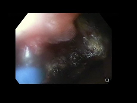 La coagulation par plasma d'argon due à une tumeur de l`ampoule de Vater.