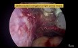 Hystérectomie laparoscopique totale pour un fibrome utérin à l'aide d'un seul dispositif d'énergie hybride