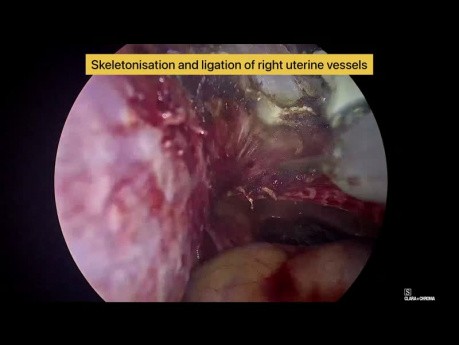 Hystérectomie laparoscopique totale pour un fibrome utérin à l'aide d'un seul dispositif d'énergie hybride