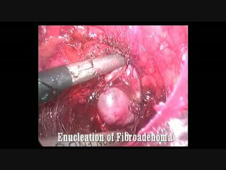 Exérèse endoscopique du fibroadénome