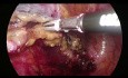Hémicolectomie gauche élargie par laparoscopie (intervention de Deloyers)