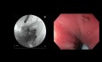 Gastroentérostomie guidée par EUS