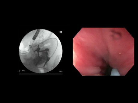 Gastroentérostomie guidée par EUS