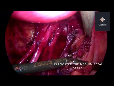 L'identification de l'artère rectale moyenne lors de la chirurgie de l'endométriose