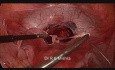 Cerclage du col de l'utérus par voie cœlioscopique