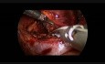 Surrénalectomie droite par cœlioscopie chez un enfant de 9 mois 