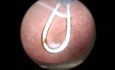 Microhystéroscopie : Astuces pour la Sténose Cervicale
