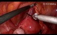 Ovariopexie pour torsion d'annexe récurrente - Cœlioscopie