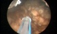 Laser Greenlight HPS - Prostate après curiethérapie