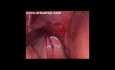 Cerclage du col de l'utérus par voie laparoscopique