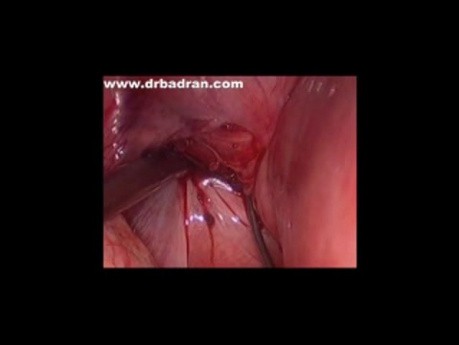 Cerclage du col de l'utérus par voie laparoscopique